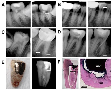 Radiographic And Histologic Evaluation Of Partial Pulpotomy With Three
