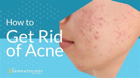 Acne Treatment Explained By Dermatologist Youtube