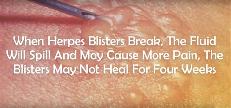 Avoid touching the area until it has fully healed, as this can cause further irritation. Difference between ingrown pubic hair and herpes ...
