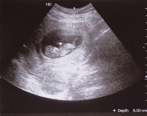 Miscarriage After Detecting A Heartbeat On Ultrasound