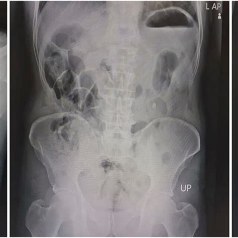 Chest X‐ray Erect Position Left Normal Chest X‐ray No Signs Of