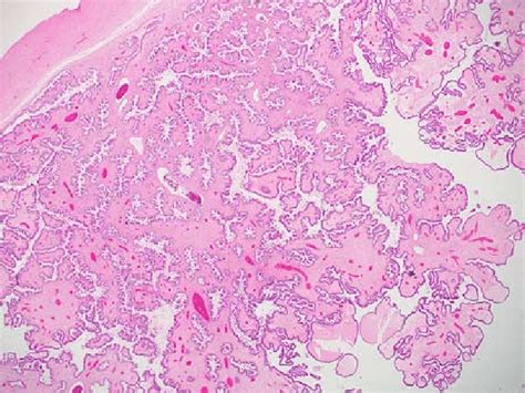 Photomicrograph Of An Ovarian Tumor Showing Papillary Projections With