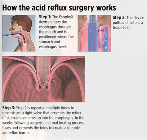 New Incision Free Surgery Available In West Michigan To Treat Acid