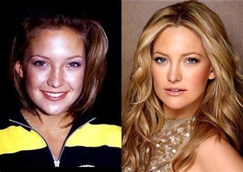Kate Hudson Plastic Surgery Before After Breast Implants