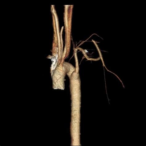 Right Aortic Arch With Aberrant Left Subclavian Artery Radiology Case