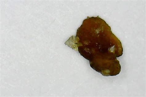 4mm Kidney Stone With An Arrowhead Sticking Out Rmildlyinteresting