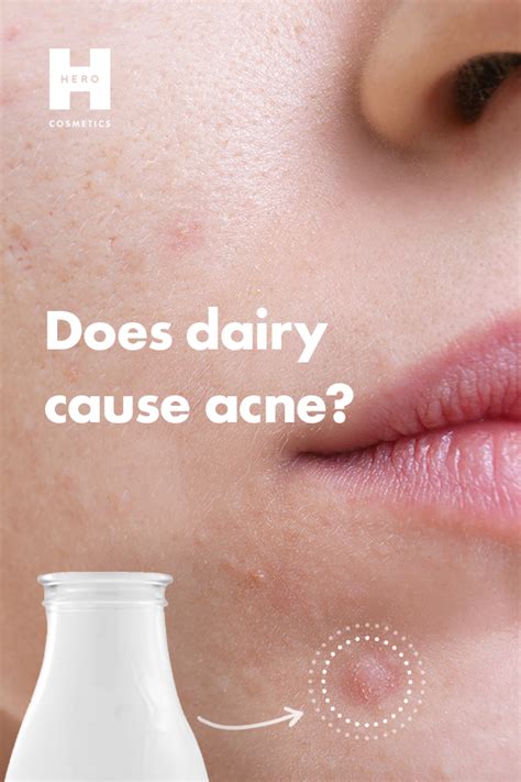 Dairy And Acne Skin Care Acne Acne Prone Skin Acne Clinic Aesthetic