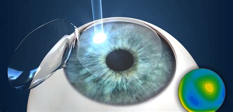 Lasik Eye Surgery Dougherty Laser Vision