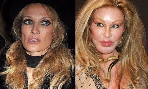 Before And After Plastic Surgery Plastic Surgery Cosmetic Surgery Plastic Surgery Gone Wrong