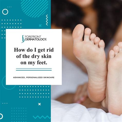 How To Get Rid Of Dry Skin On My Feet Forefront Dermatology
