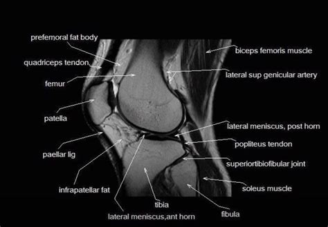 Mri Anatomy Of The Knee Knee Mri Mri Knee Doctor