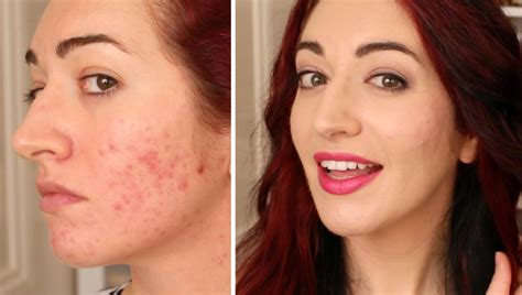 24 best products for acne scars including acne scar creams serums and more ~ news makeup blog