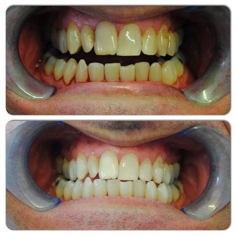 With this method, each grout line is brushed individually with a small brush and sealant. Tooth Whitening - Barlanark Dental Practice