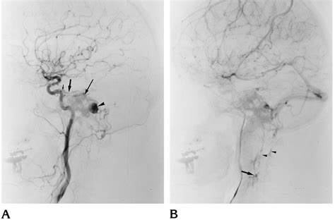 Lateral Views Of Left Common Carotid Artery Angiograms In A 36 Year Old