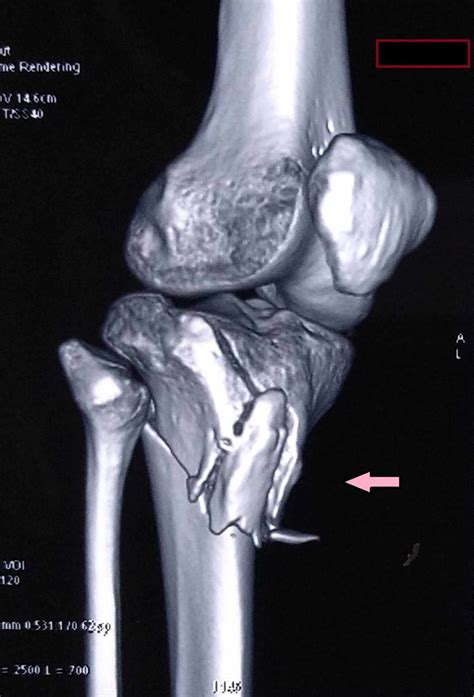 Three Dimensional Computed Tomography Image Showing A Bicondylar