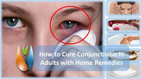How To Cure Conjunctivitis In Adults With Home Remedies Youtube