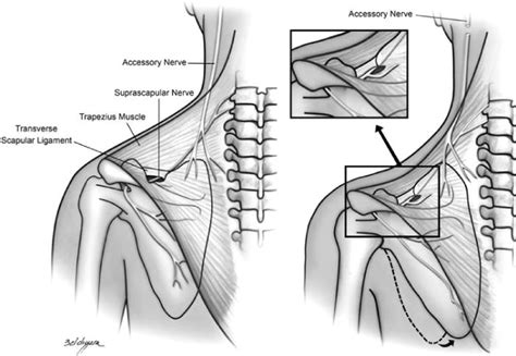 Suprascapular Nerve Release For Treatment Of Shoulder And Periscapular