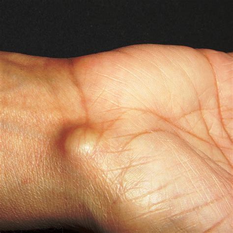 How Do I Get Rid Of A Ganglion Cyst On My Finger Duane Pickrell Kapsels