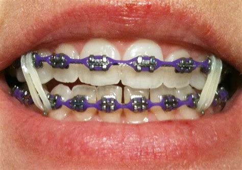 With the patient we showed earlier, you can see that braces with rubber bands helped to fix her overbite and give her a great smile. #BracesProblems