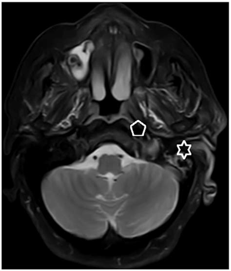 Axial Mri Showing Swelling And Edema Of The Left Ear Star Soft