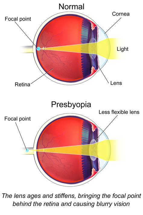 Midtown Optometry Treating Presbyopia With Digital Progressive Lenses