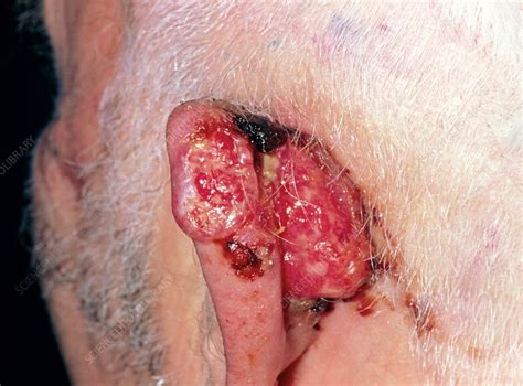 A Squamous Cell Carcinoma Of The Ear Stock Image M1310170