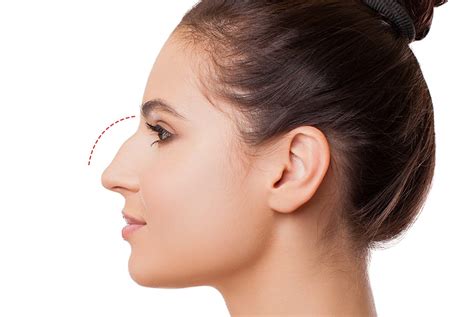 Bump On Nose Or Crooked Nose Non Surgical Rhinoplasty Treatment At Define Clinic Beaconsfield