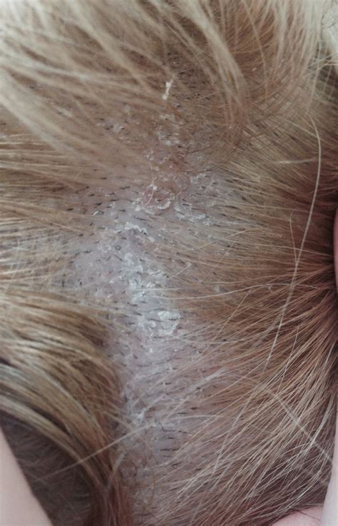 Auch ein zuckerpeeling kann dabei helfen, die pickel am rücken loswerden zu können. Chloasma Durch Pille Preise