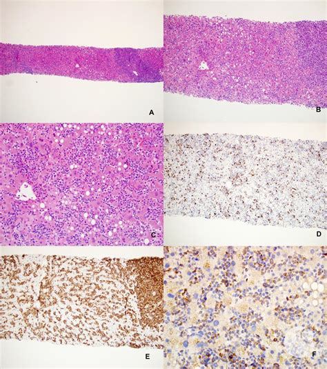 Defeat of the skin and lymph nodes, enlarged liver and spleen (hepatosplenomegaly), complete. Hepatosplenic T cell lymphoma