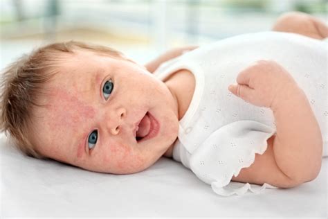 Baby Rashes Causes And Treatments Giggle Magazine