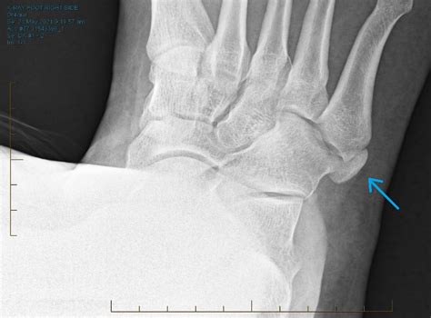 Accessory Bones Of The Foot And Ankle Orthosports