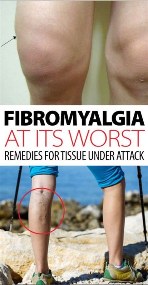 What Is Fibromyalgia Swelling And What Causes It Skms