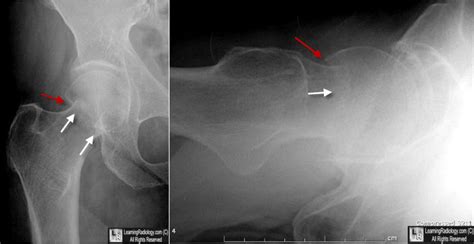 Learning Radiology Fractures Of The Proximal Femur Femoral Neck