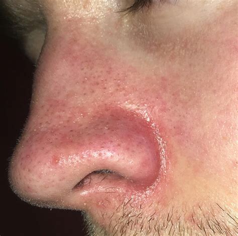 Flaky Skin On Nose