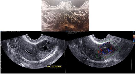 Transvaginal Ultrasound In Evaluation And Follow Up Of Ovarian Granulosa Cell Tumors