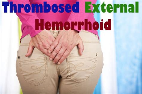 This is performed in a hospital under general. Are you suffering from External Hemorrhoid or Perianal Hematoma? Lets' have the discussion on ...