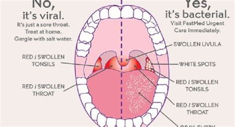Throat Diagram Tonsils