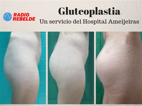 Gluteoplastia Un Servicio Del Hospital Hermanos Ameijeiras Audio