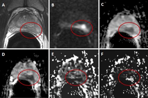 3t Multiparametric Mri Of The Prostate Does Intravoxel Incoherent