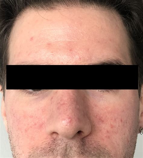 Acne Rosacea Rosacea And Facial Redness Forum