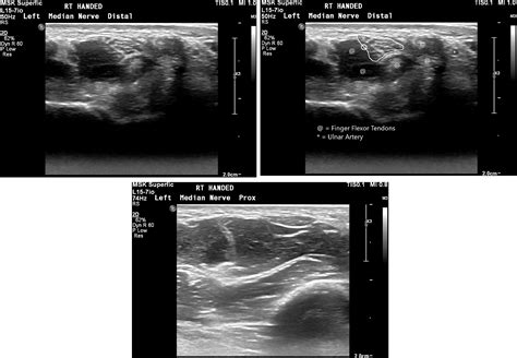 Normative Values For The Sonographic Measurement Of The Pediatric