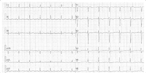 It Shows Ekg Abnormalities T Waves Inversion In Leads V V Flat T
