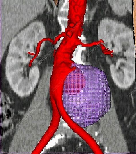 Aortic Aneurysm Ct Scan Stock Image C0353579 Science Photo Library