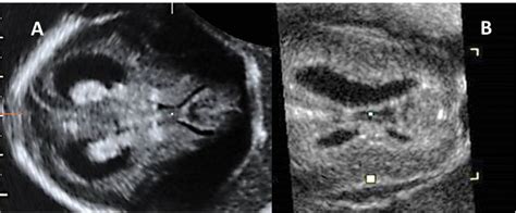Fetal Mild Ventriculomegaly Still A Challenging Problem