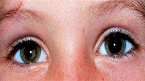 3 sebab utama mata ditumbuhi ketumbit. Ada Bintik Putih Di Kelopak Mata Bagian Dalam - Berbagai Mata