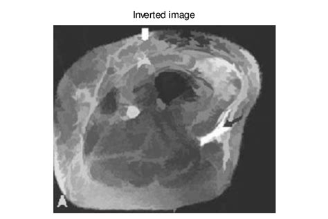 Axial Fat Suppressed T2 Weighted Image Image Courtesy Radiology And