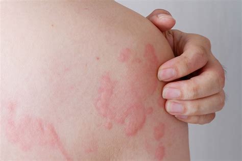 Postpartum Hives Causes Symptoms Treatment And Remedies
