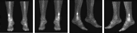 Stress Fracture Foot And Shin Causes Symptoms Prevention And Treatment