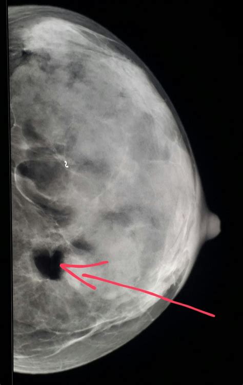 What Does Breast Cancer Look Like On 3d Mammogram ️ Updated Guide 2022