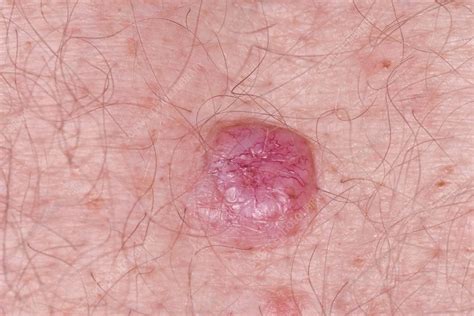 Basal Cell Carcinoma Skin Cancer Stock Image C0345450 Science